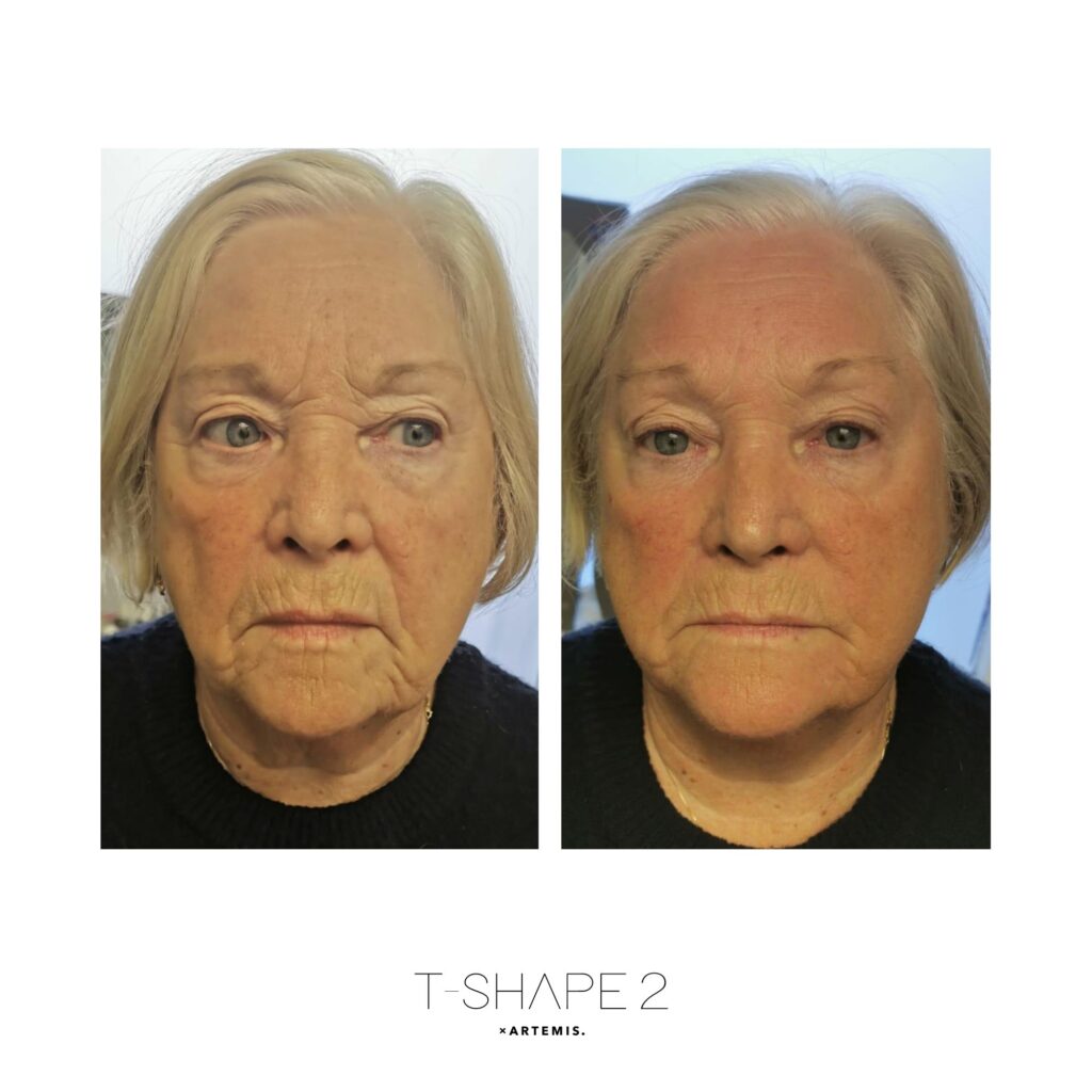 Before and after &mdash; Face