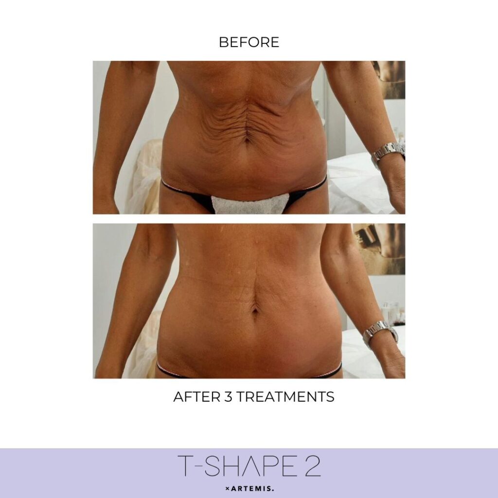 Before and after &mdash; Abdomen