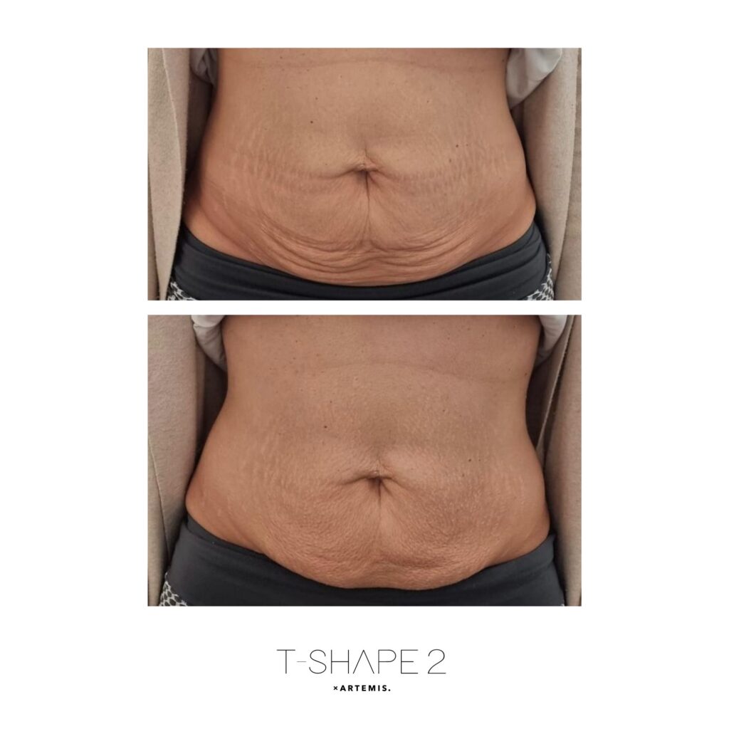 Before and after &mdash; Post-weight-loss abdomen