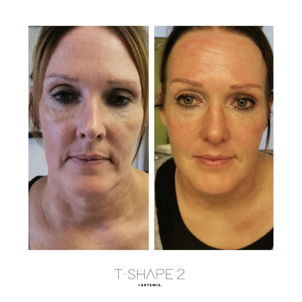 Before and after &mdash; Face