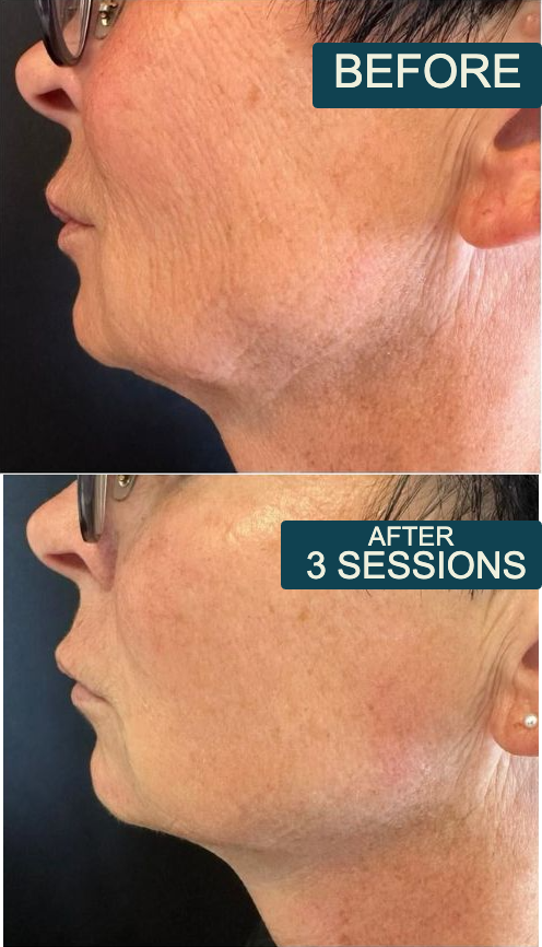 Before and after three T-Shape 2 sessions &mdash; jawline and neck skin tightening