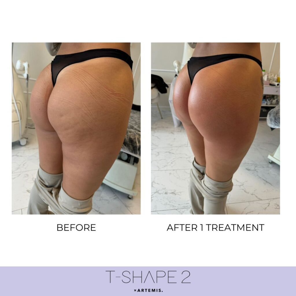 Before and after &mdash; Legs