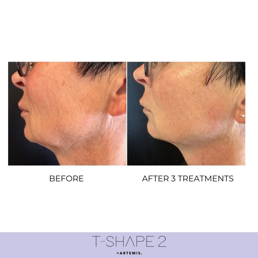 Before and after &mdash; Neck & jawline